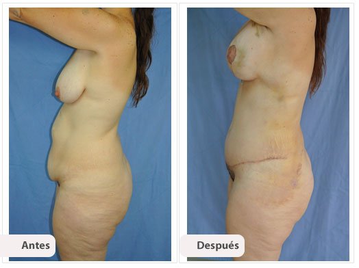 Cirugía Mami Makeover: Perfil Caso 5