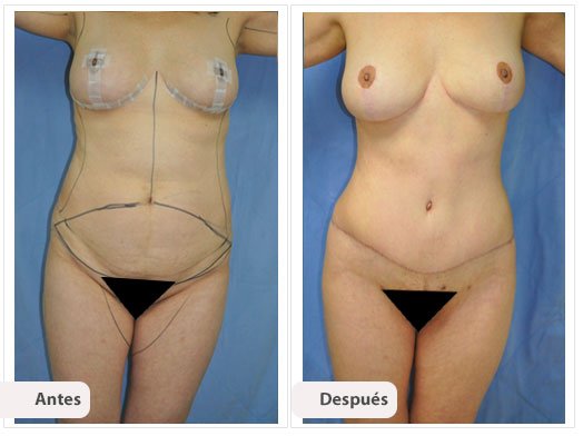Cirugía Mami Makeover: Caso 6