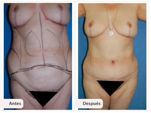 Cirugía Mami Makeover: Caso 7