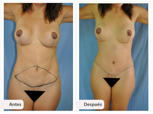 Cirugía Mami Makeover: Caso 8