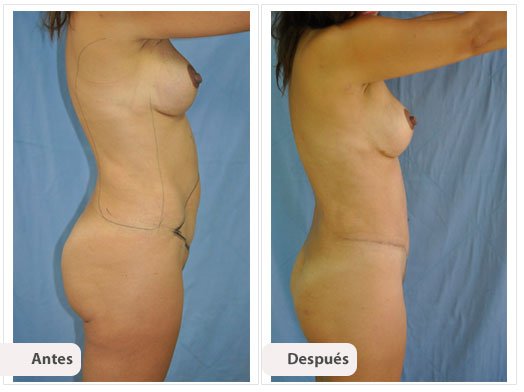 Cirugía Mami Makeover: Perfil Caso 8