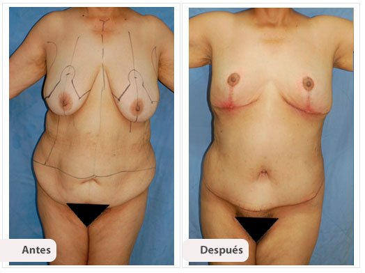 Cirugía Mami Makeover: Perfil Caso 9