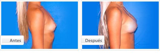 Mamoplastia de Aumento : Perfil Caso 1