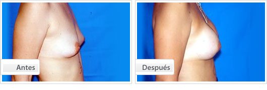 Mamoplastia de Aumento : Perfil Caso 2