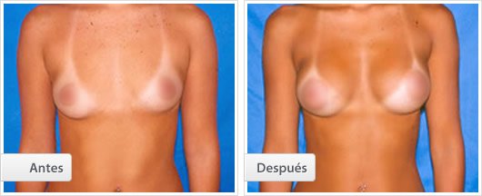 Mamoplastia de Aumento : Caso 1