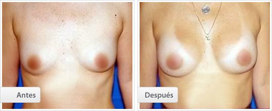 Mamoplastia de Aumento : Caso 2