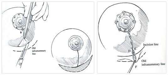 Mastopexia con Cicatriz T Corta