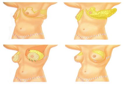 Mamoplastía + Toracoplastia