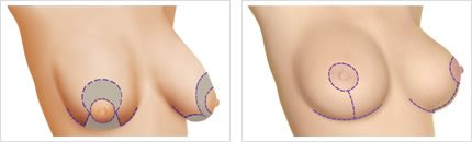 Cicatriz de la T Invertida Clásica