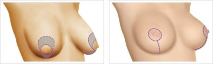 Técnica con Cicatriz Vertical