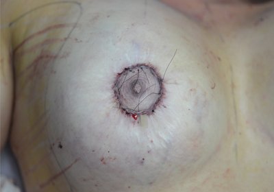 Mastopexia Peri Areolar : Post Operatorio
