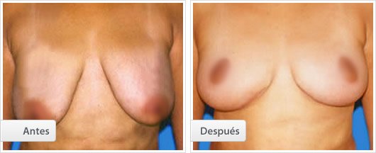 Mamoplastía Reductiva: Caso 1