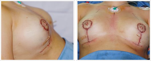 Mamoplastía Reductiva con Cicatriz T Corta: Perfil y Frente
