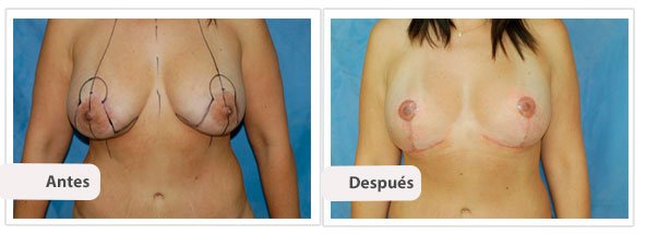 Mastopexia con Implantes T Invertida: Caso 1