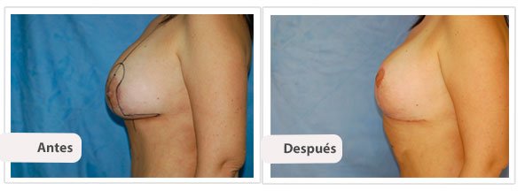 Mastopexia con Implantes T Invertida: Perfil Caso 1
