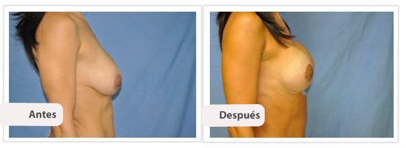 Mastopexia con Implantes T Invertida: Perfil Caso 2