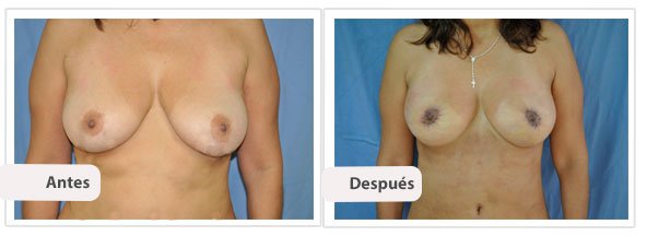 Mastopexia con Implantes T Invertida: Caso 2