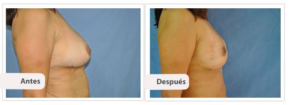 Mastopexia Peri Areolar: Perfil Caso 2