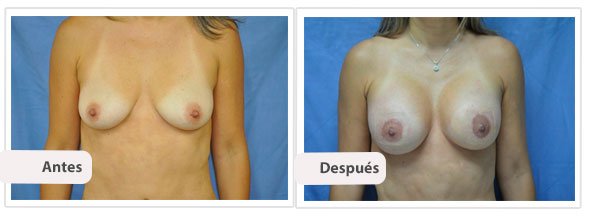 Caso 1: Modelo: Moderado plus – Tamaño 300 cc