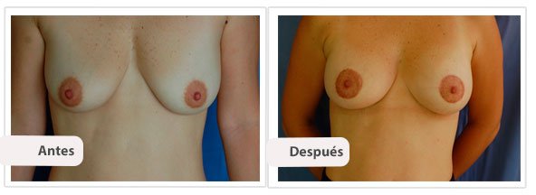 Caso 2: Modelo: Moderado - Tamaño: 200 cc