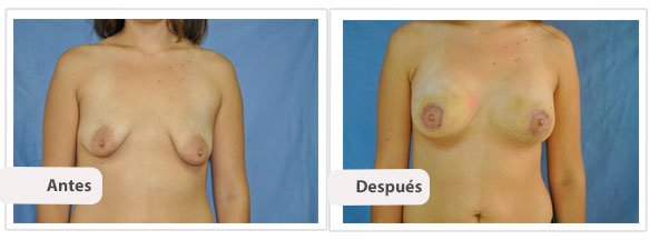 Caso 3: Modelo: Moderado Plus - Tamaño: 375 cc