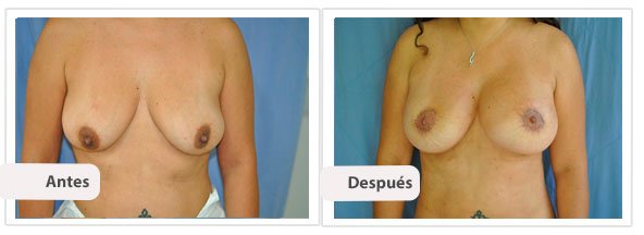 Caso 6: Modelo: Moderado Plus - Tamaño: 400 cc