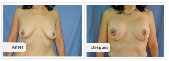 Mastopexia T Corta con Implantes: Caso 1