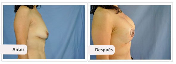 Mastopexia T Corta con Implantes: Perfil Caso 1