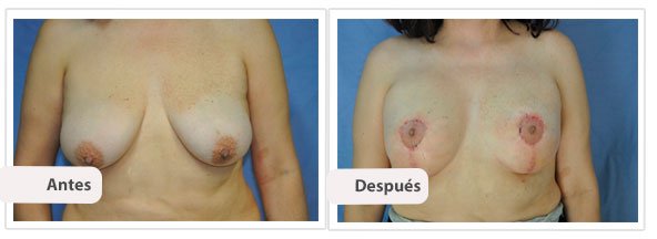 Mastopexia T Corta con Implantes: Caso 2