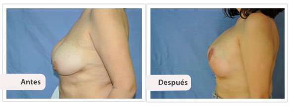 Mastopexia T Corta con Implantes: Perfil Caso 2