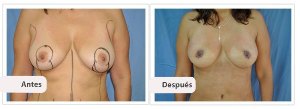 Mastopexia T Corta con Implantes: Caso 3
