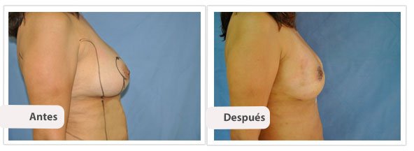 Mastopexia T Corta con Implantes: Perfil Caso 3
