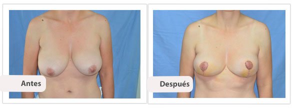 T invertida Mc Kissock: Caso 1