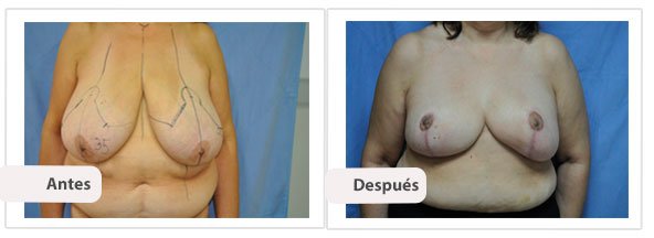 T invertida Mc Kissock: Caso 9