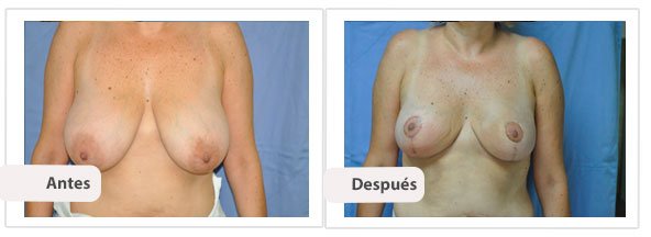 T invertida Mc Kissock: Caso 10