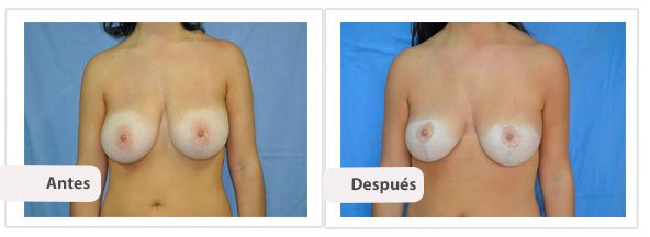 T invertida Mc Kissock: Caso 11