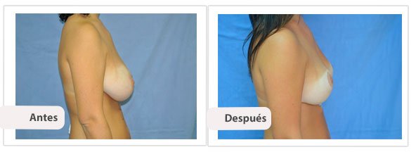 T invertida Mc Kissock: Perfil Caso 11