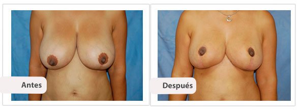 T invertida Mc Kissock: Caso 12