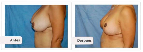 T invertida Mc Kissock: Perfil Caso 12