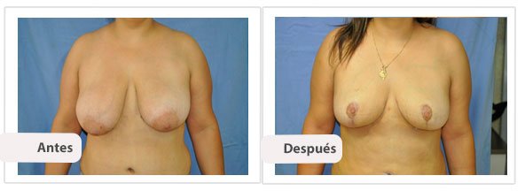 T invertida Mc Kissock: Caso 13