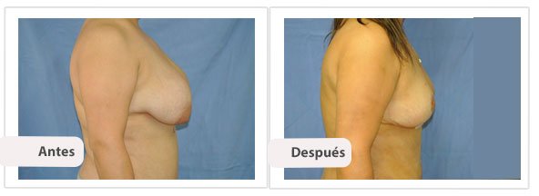 T invertida Mc Kissock: Perfil Caso 13