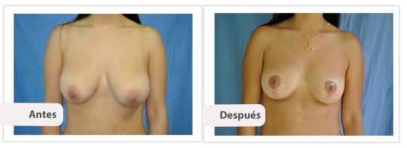 T invertida Mc Kissock: Caso 14