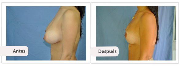 T invertida Mc Kissock: Perfil Caso 14