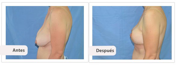 T invertida Mc Kissock: Perfil Caso 1