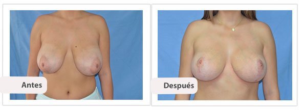 T invertida Mc Kissock: Caso 2