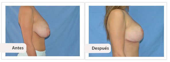 T invertidaMc Kissock: Perfil Caso 2