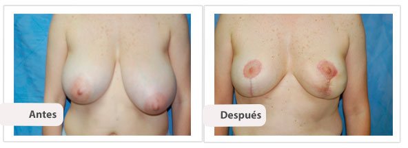 T invertida Mc Kissock: Caso 3