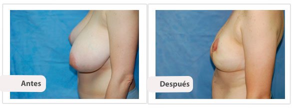 T invertidaMc Kissock: Perfil Caso 3