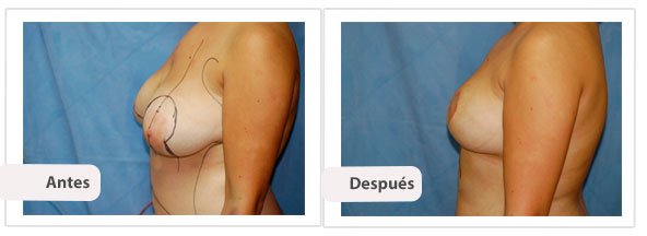 T invertida Mc Kissock: Perfil Caso 4