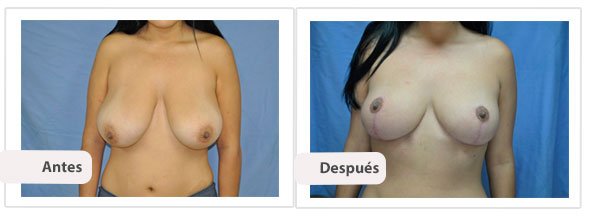 T invertida Mc Kissock: Caso 5